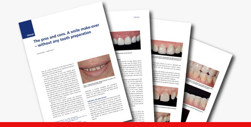 The pros and cons A smile make over without any tooth preparation