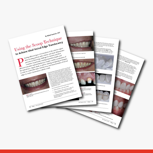 Using the Scoop Technique to Achieve Ideal Incisal Edge Translucency
