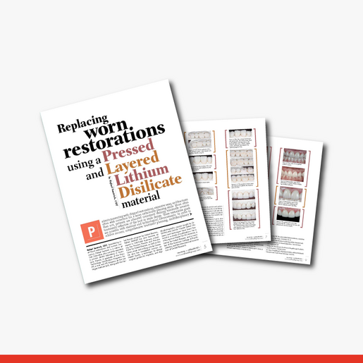 Replacing Worn Restorations Using a Pressed 2