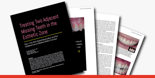 Treating Two Adjacent Missing Teeth 1