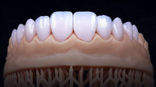 Veneers types 04