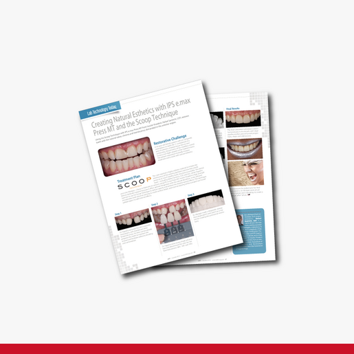 Creating Natural Esthetics with IPS e max Press MT and the Scoop Technique A comprehensive approach for restoring esthetics