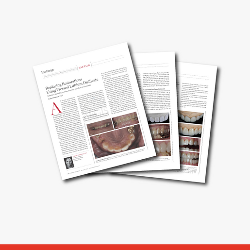 Replacing Restorations Using Presse