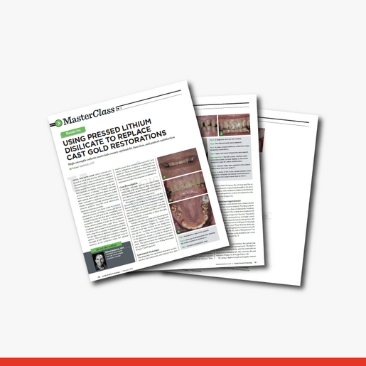 Using Pressed Lithium Disilicate