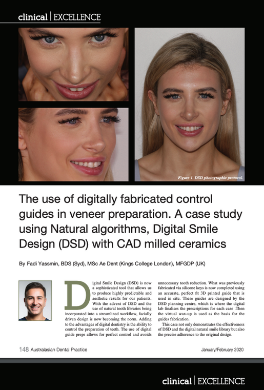 The use of digitally fabricated control guides in veneer preparation