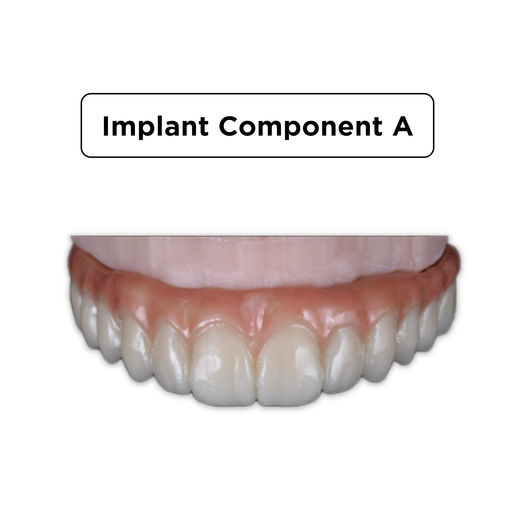 Implant Component Implant Component A 2