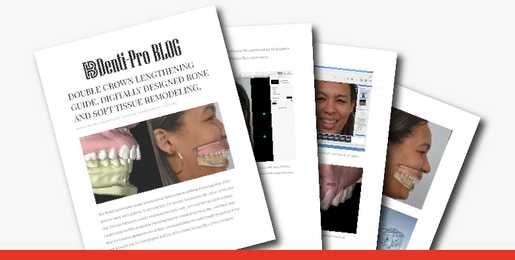 DOUBLE CROWN LENGTHENING GUIDE DIGITALLY DESIGNED BONE AND SOFT TISSUE REMODELING