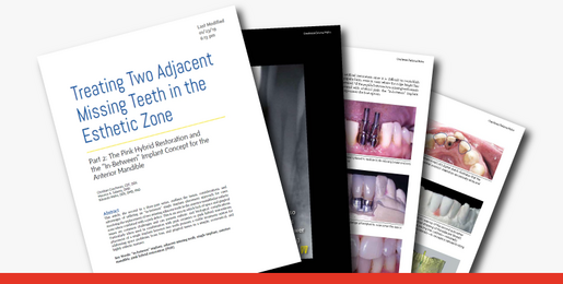 Treating Two Adjacent Missing Teeth 1