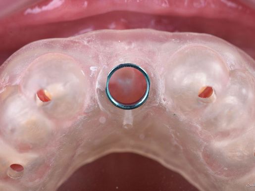 Singlepartial implant planning 1 new