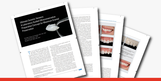Ultimate ceramic veneers a laboratory