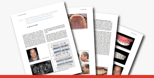 Rehabilitating an Edentulous Maxilla