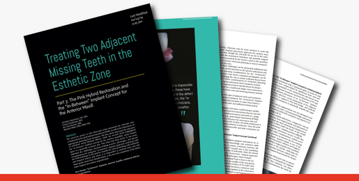 Treating Two Adjacent Missing Teeth