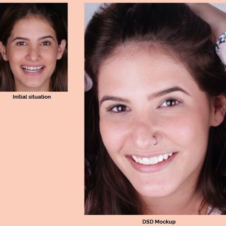 DSD Moti Before After