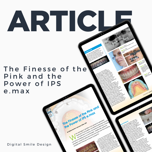 SQUARE thumbnail The Finesse of the Pink and the Power of IPS e max