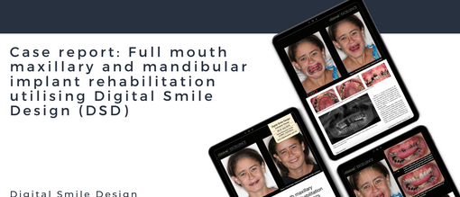 Case report Full mouth maxillary and mandibular implant rehabilitation utilising Digital Smile Design DSD