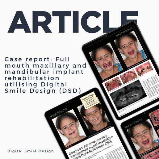 SQUARE thumbnail Case report Full mouth maxillary and mandibular implant rehabilitation utilising Digital Smile Design DSD