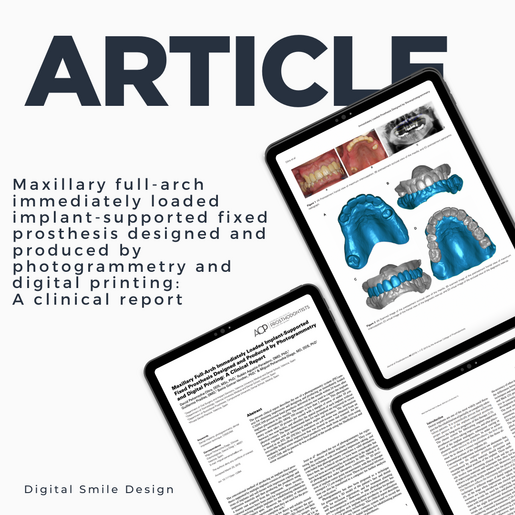 SQUARE thumbnail Maxillary full arch immediately loaded implant supported fixed prosthesis designed and produced by photogrammetry and digital printing a clinical report