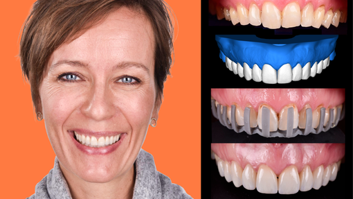 LEARNING HUB ARTICLE THUMBNAIL Standard vs digitally guided protocols A veneers case study