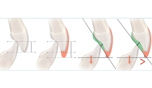 OCCLUSAL VERTICAL DIMENSION TREATMENT PLANNING DECISIONS AND MANAGEMENT CONSIDERATIONS LEARNING HUB ARTICLE IMAGE