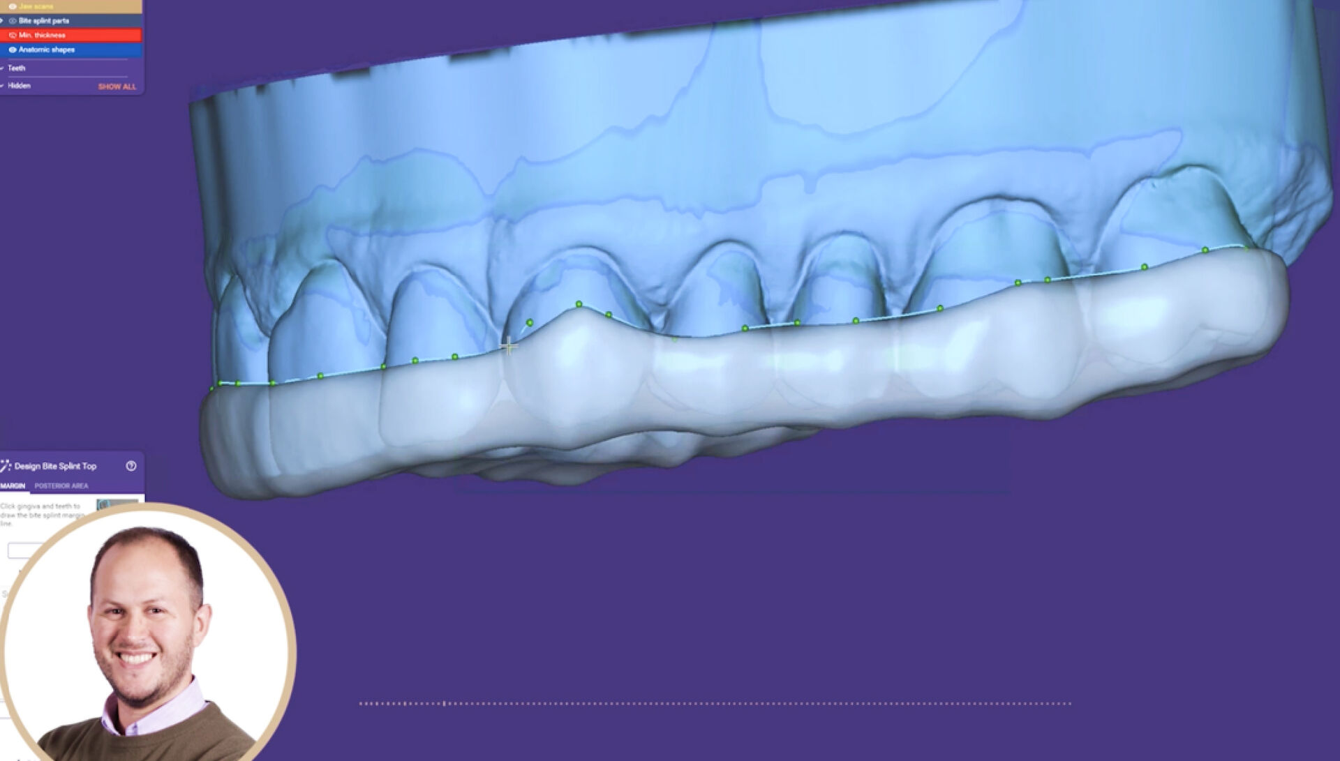 Bite splint design tips from the dsd planning center