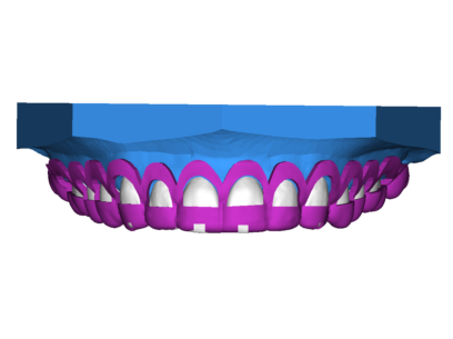 Crown Lengthening 2