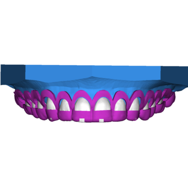 Crown Lengthening 2