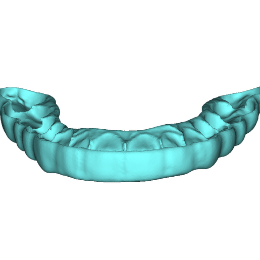 Bite Splint 1