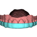 Bite Splint 3