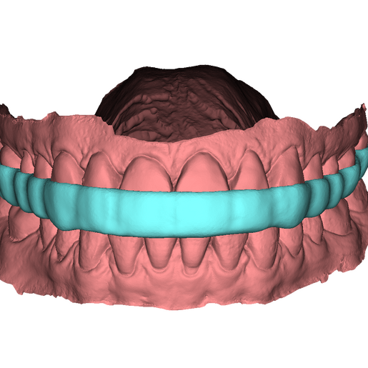 Bite Splint 4