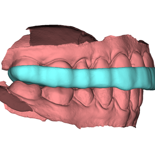 Bite Splint 5