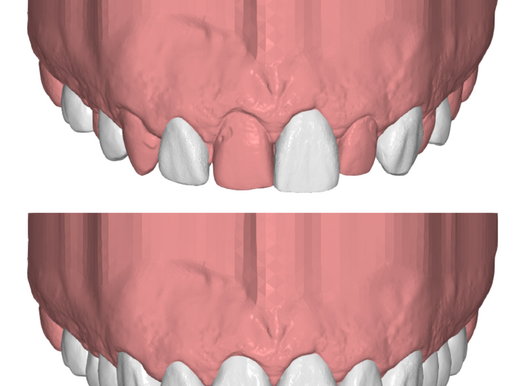 DIRECT COMPOSITE 6