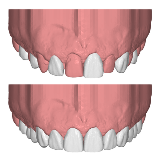 DIRECT COMPOSITE 6