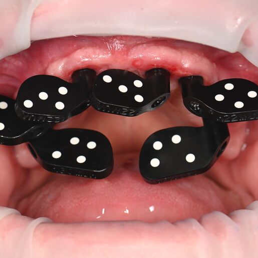 Telemetria intraoral