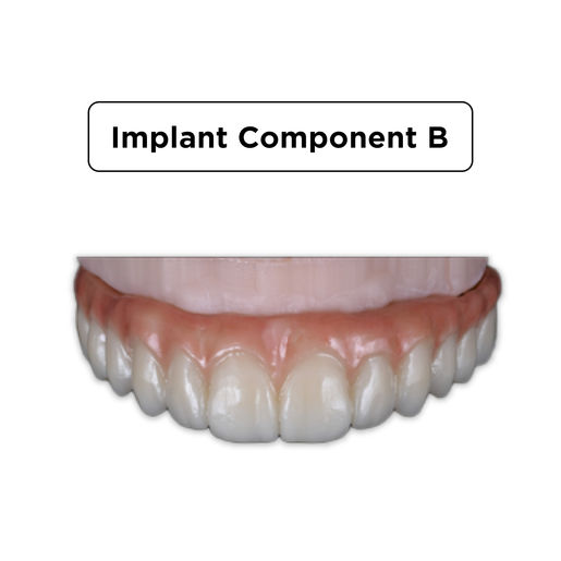 Implant Component Implant Component B