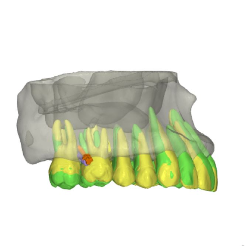8 Temporary Anchorage Device