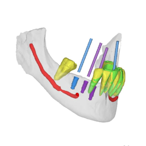 6 IMPLANT SIMULATION