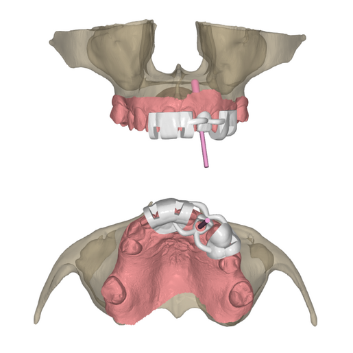 Provi 2 implants