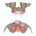 Provi 2 implants