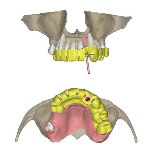 Partial 2 implants