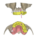 Partial 2 implants