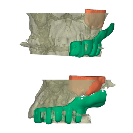 Sinus guides