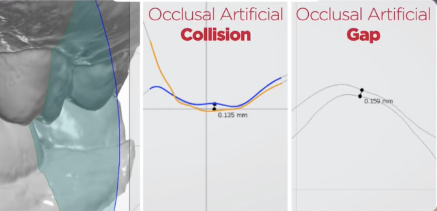 Diagram comparing three bite registration scenarios: occlusal collision where upper mesh penetrates lower mesh, occlusal gap where false separation appears between arches, and correct bite registration with accurate mesh alignment