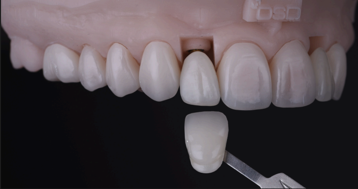 DSD Lab shade comparison