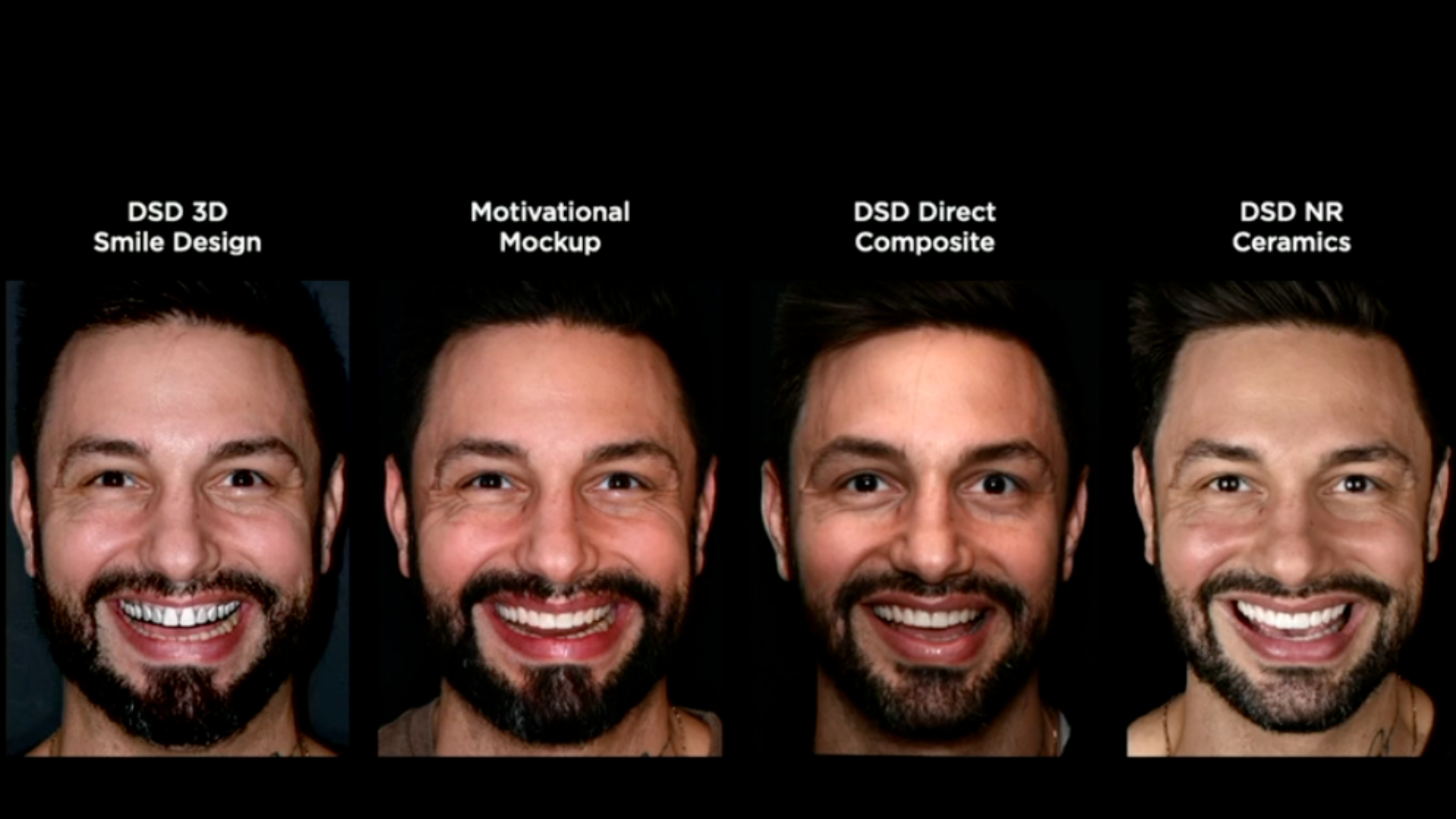 Copy-paste dentistry workflow showing how the approved provisional design becomes the exact template for the final restoration