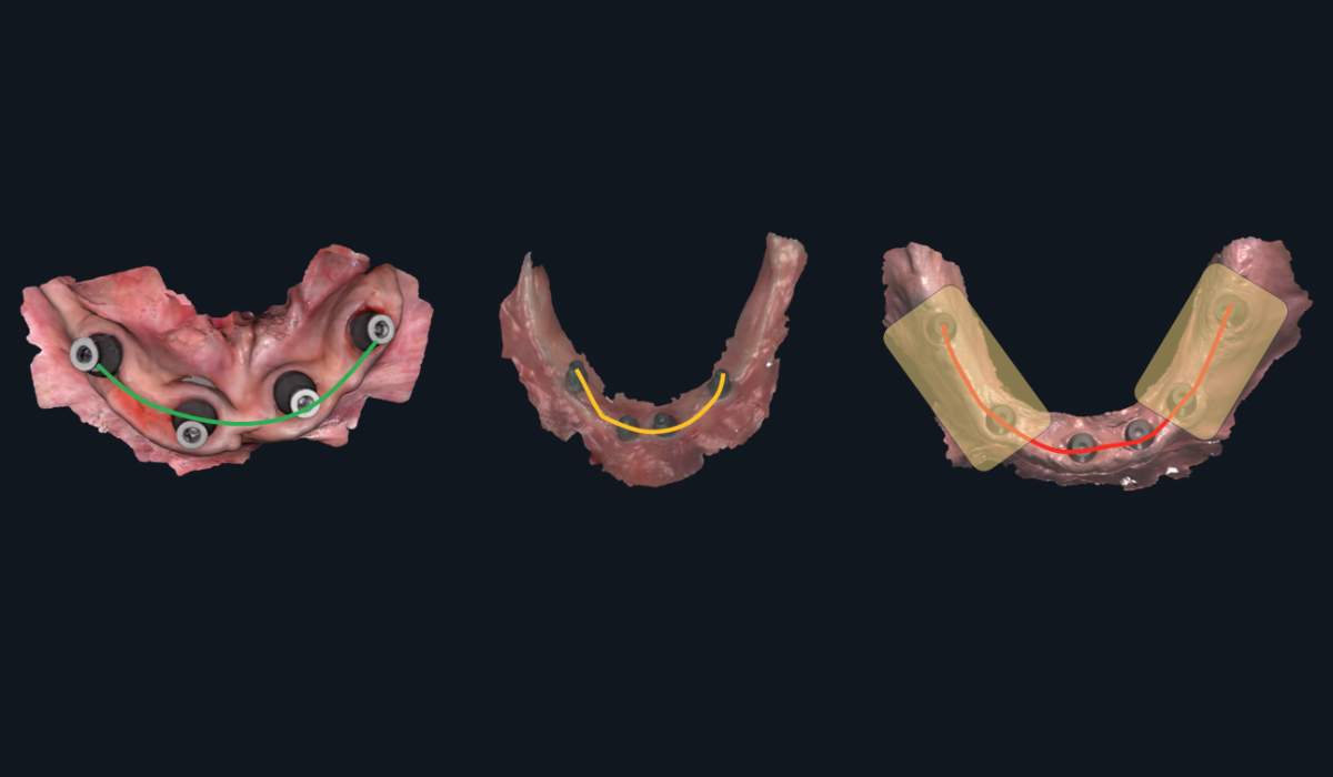 Full arch implant scanning showing the challenges of cumulative stitching error across long-span cases