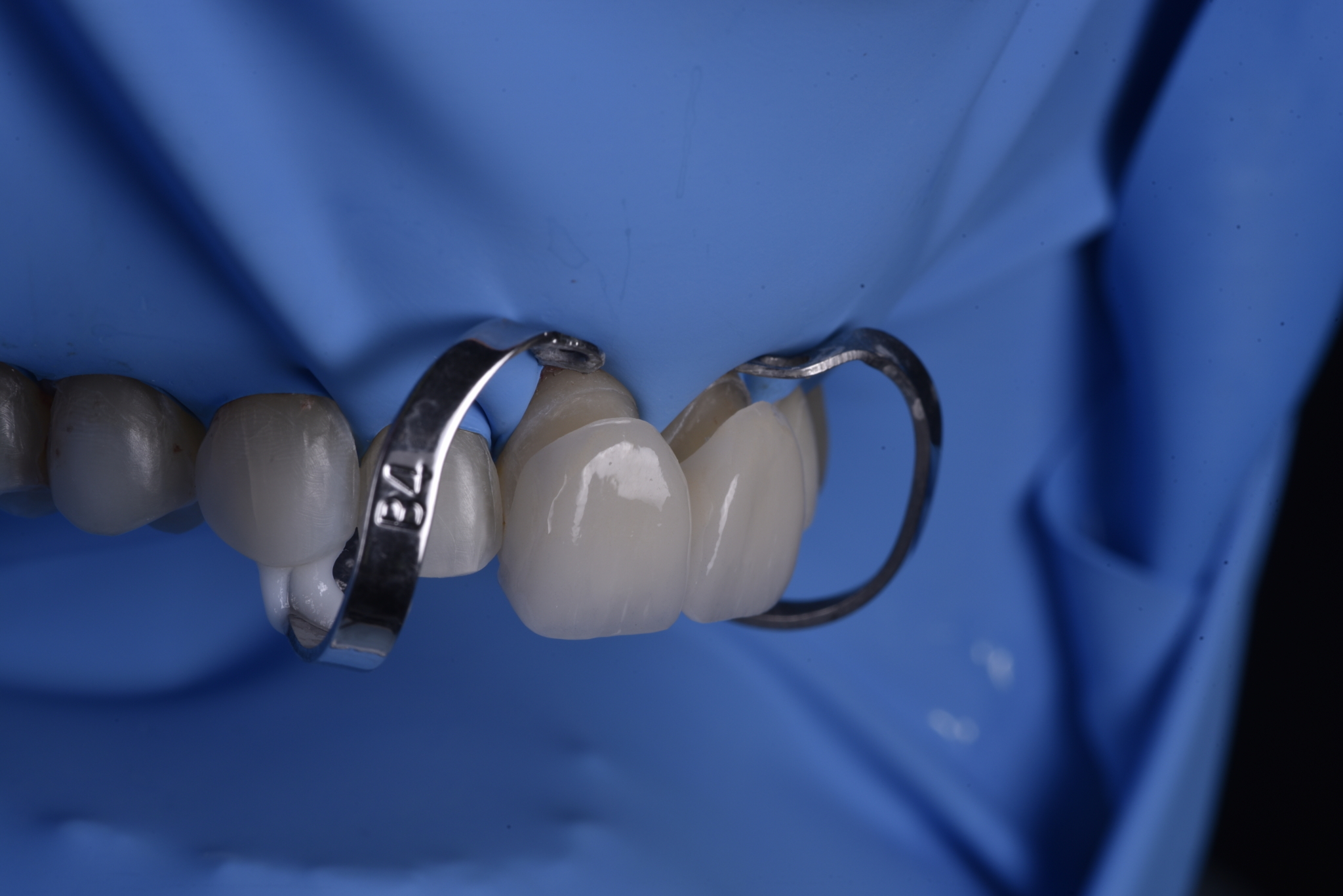 Close-up of a dental team performing veneer cementation