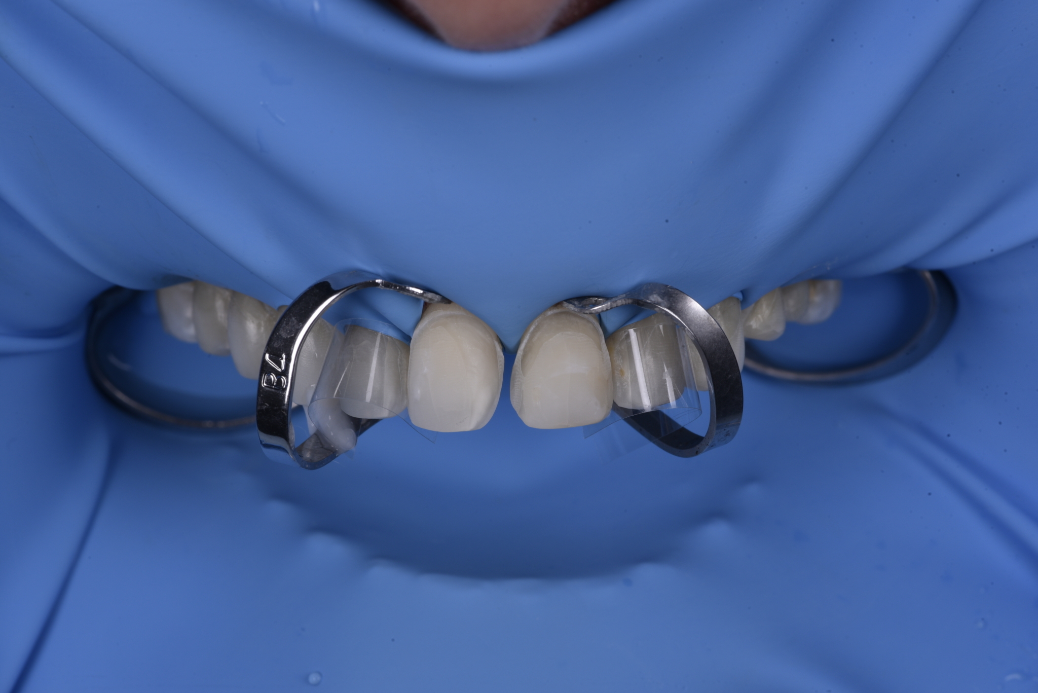 Clinician preparing a tooth for veneer bonding using relative isolation technique