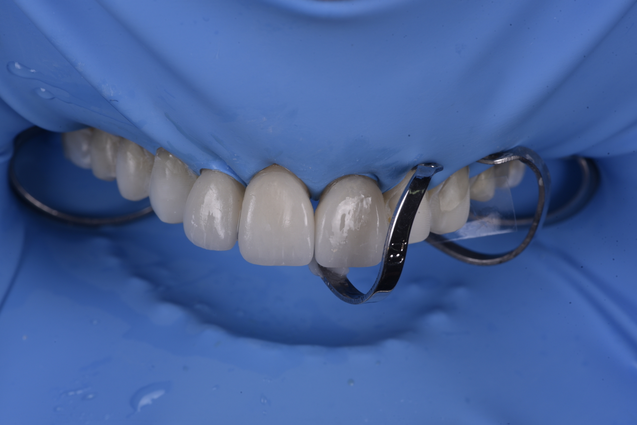 Dentist bonding a porcelain veneer with rubber dam isolation in a clinical setting