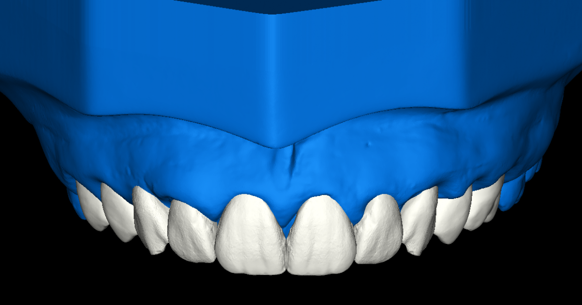 DSD Upper