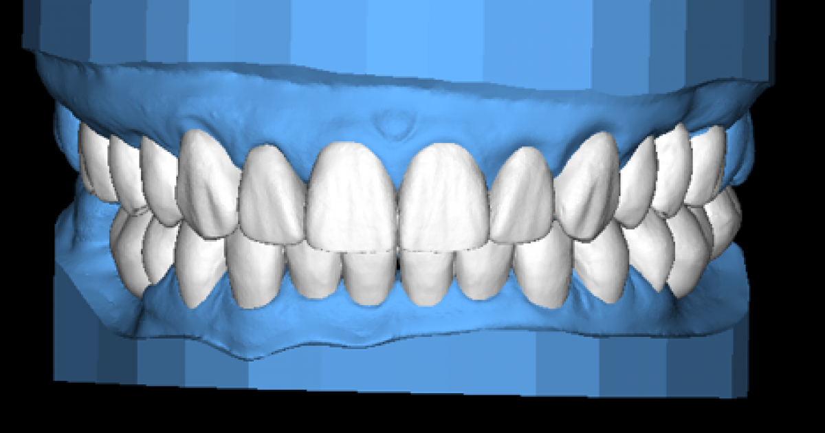 DSD Upper & Lower